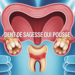 Illustration d'une dent de sagesse qui pousse